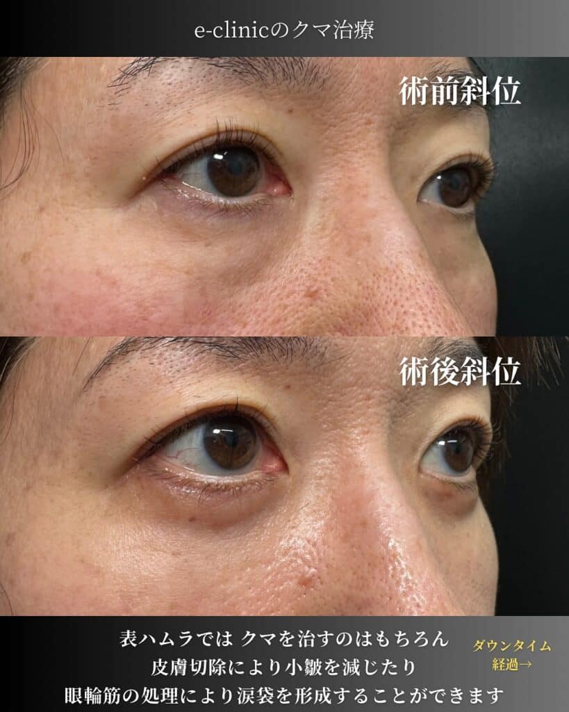 裏ハムラ法の症例写真 (5)