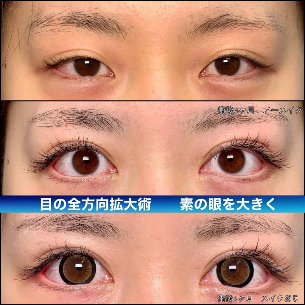 グラマラスライン形成　タレ目形成　大阪
