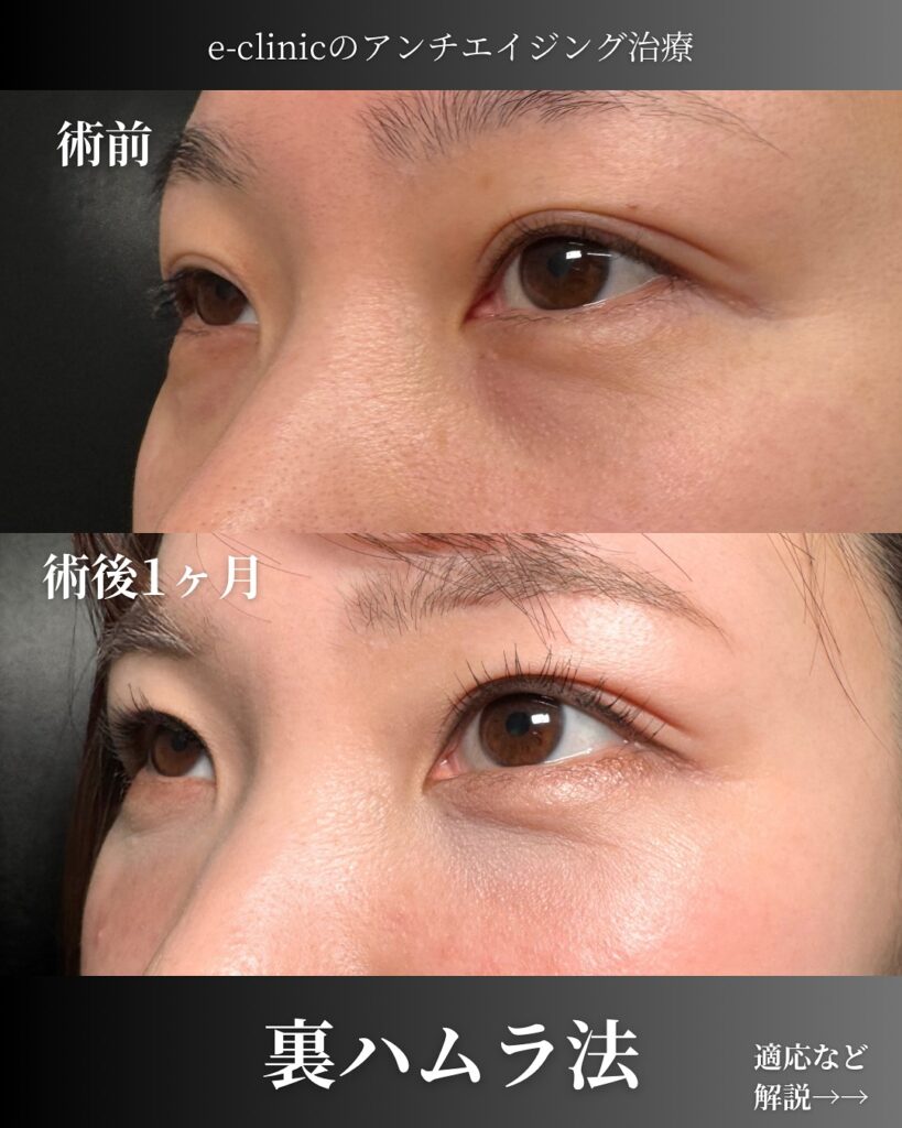 裏ハムラ法を受けた女性の症例写真 (3)