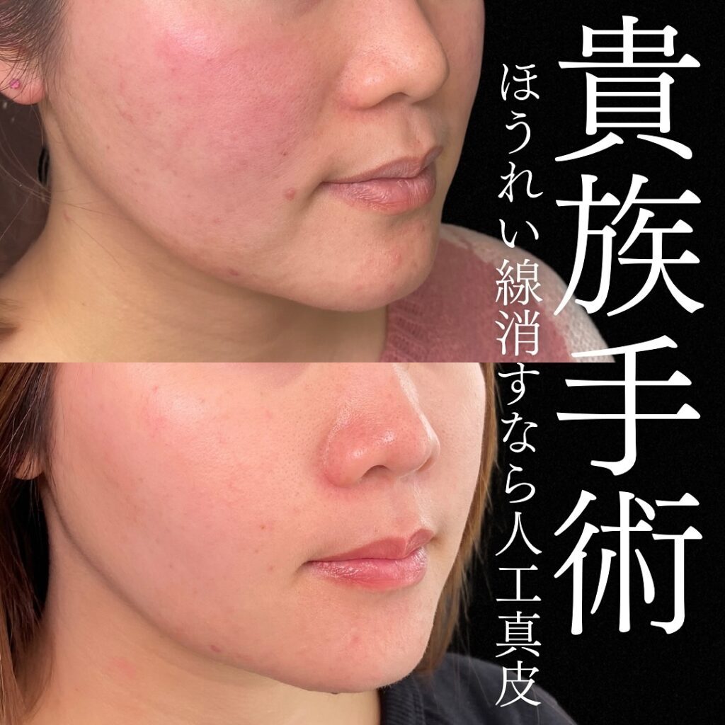 貴族手術
