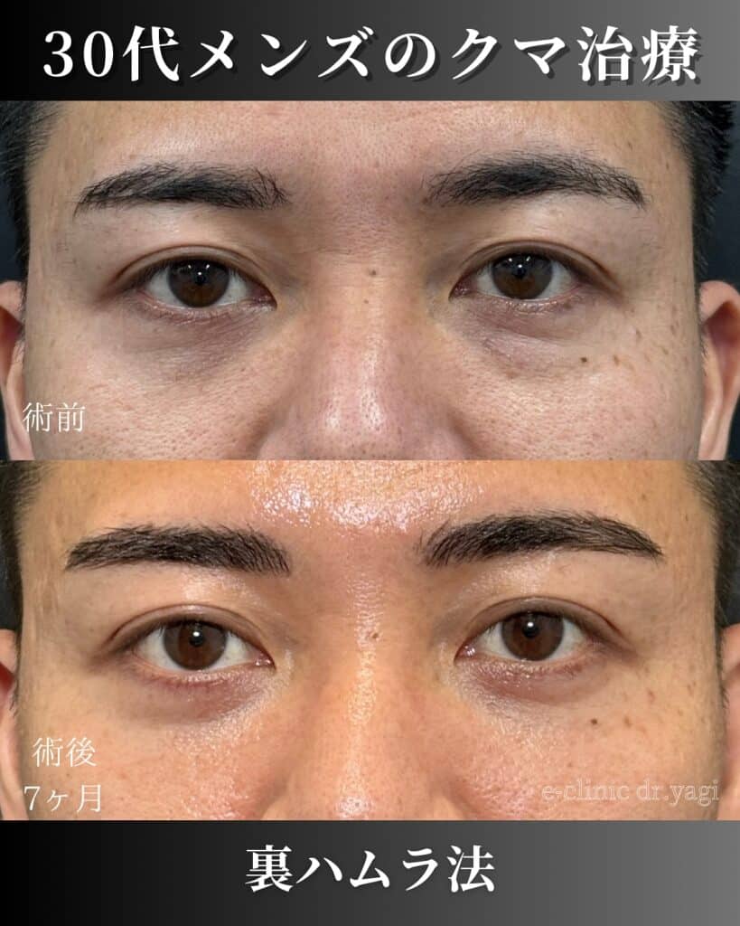 男性の裏ハムラ法の症例写真