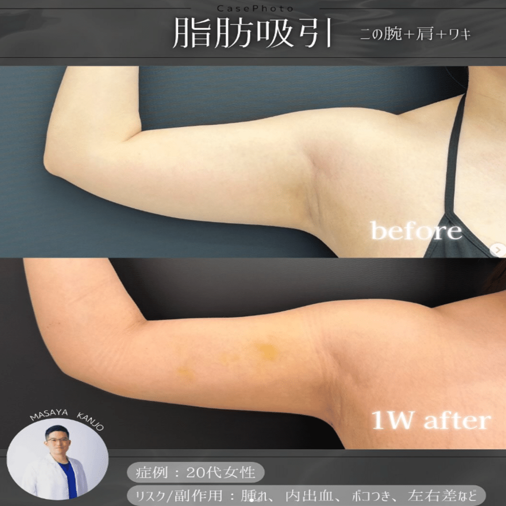 二の腕の脂肪吸引
