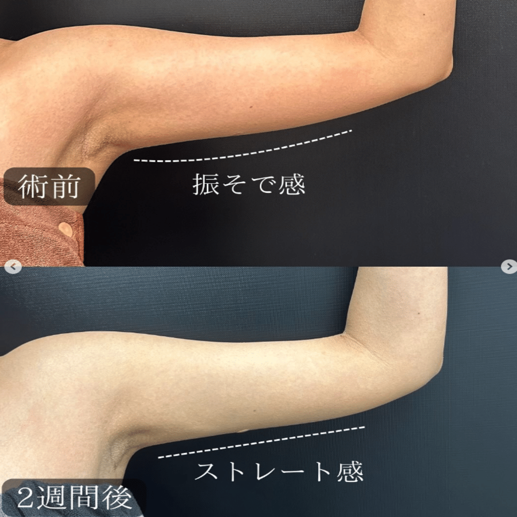 二の腕の脂肪吸引