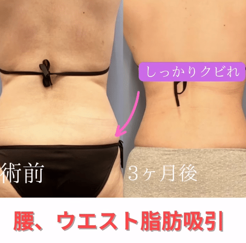 腰の脂肪吸引