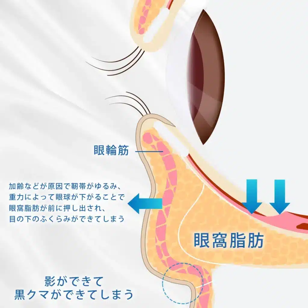 クマ・目の下のたるみの原因になる眼窩脂肪の突出についての図解