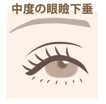 眼瞼下垂 中度