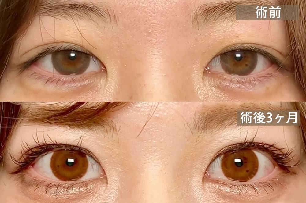 先天性眼瞼下垂