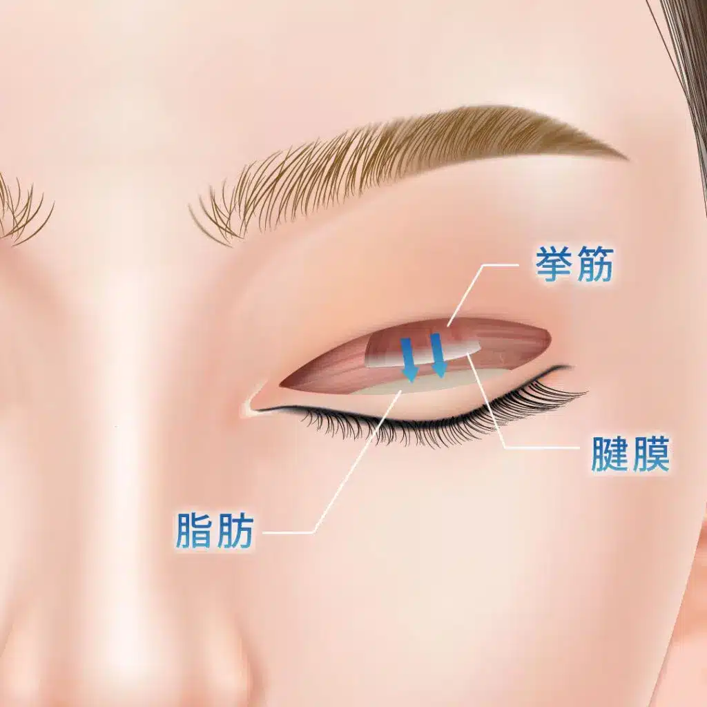 眼瞼下垂