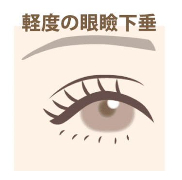 眼瞼下垂 軽度