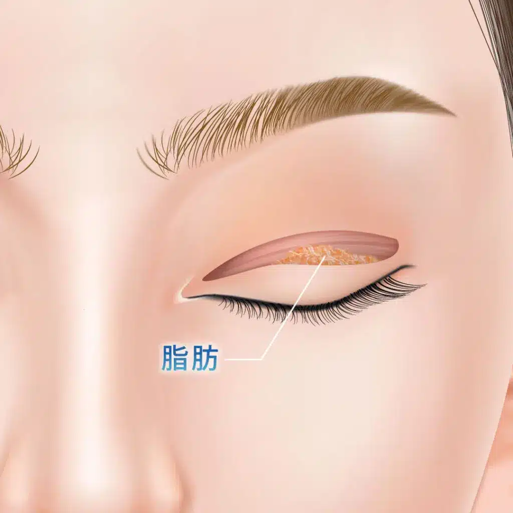 眼瞼下垂