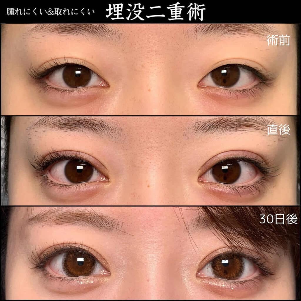 二重埋没法
