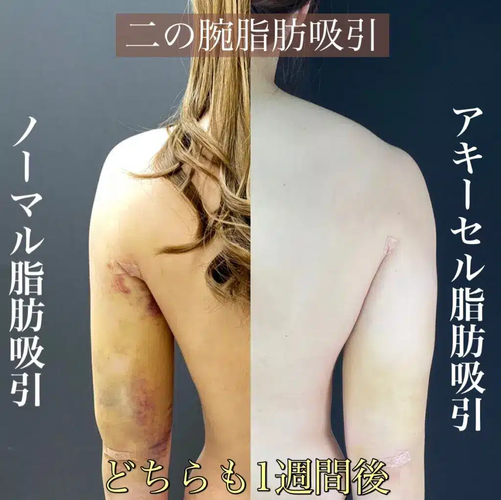脂肪吸引 アキーセル