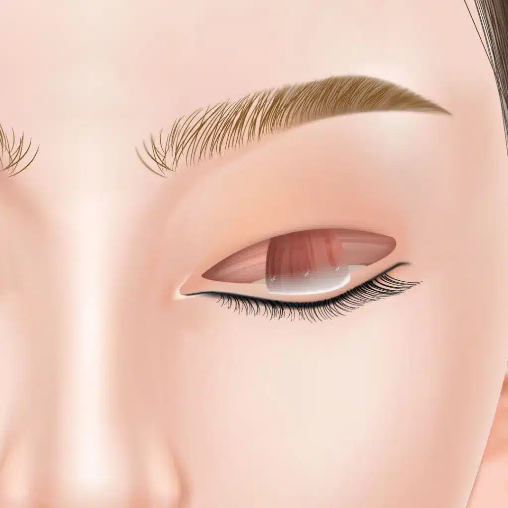 眼瞼下垂