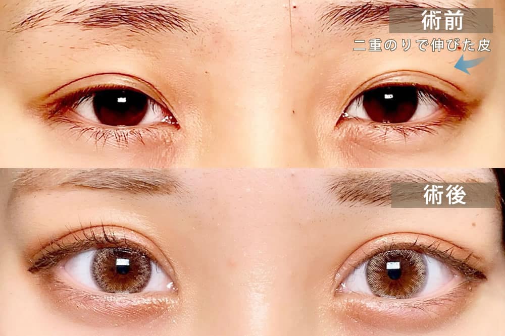 偽性眼瞼下垂