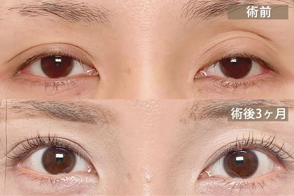 後天性眼瞼下垂 腱膜性眼瞼下垂