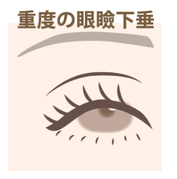眼瞼下垂 重度