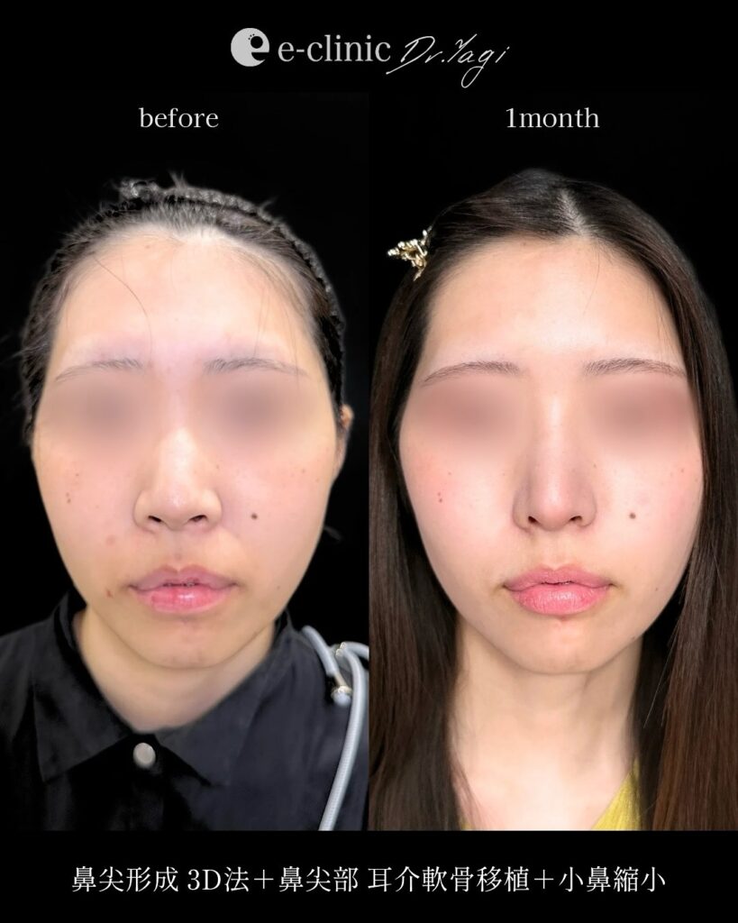 鼻尖形成3D法と耳介軟骨移植と小鼻縮小の症例写真 (3)