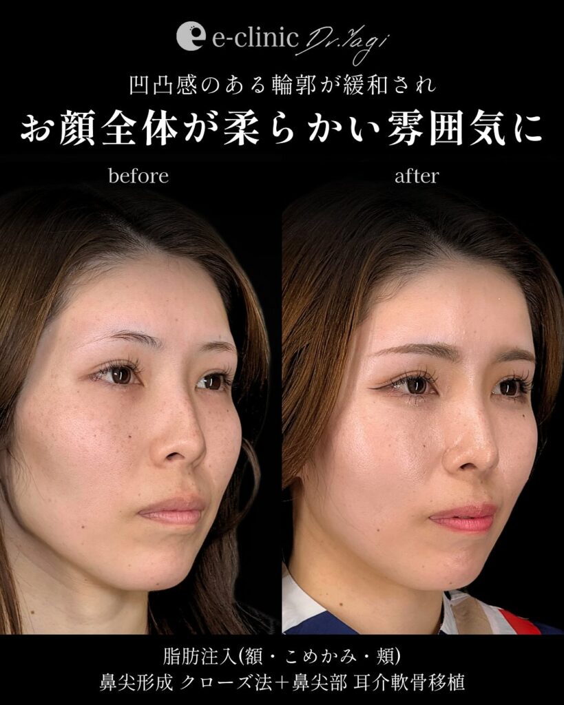 鼻尖形成と耳介軟骨移植と脂肪注入の症例写真 (4)