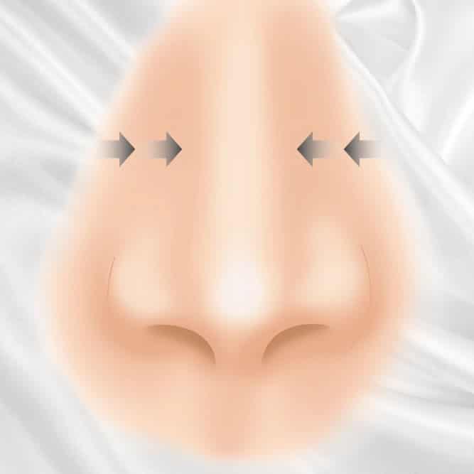 鼻骨骨切り幅寄せのイメージ