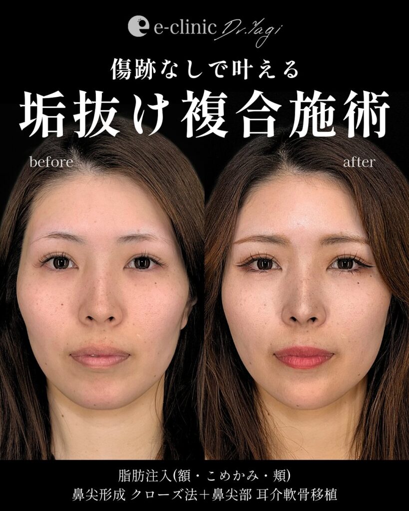 鼻尖形成と耳介軟骨移植と脂肪注入の症例写真 (2)