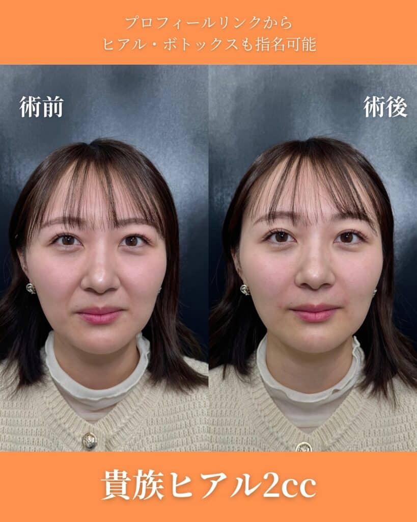 貴族ヒアルの症例写真