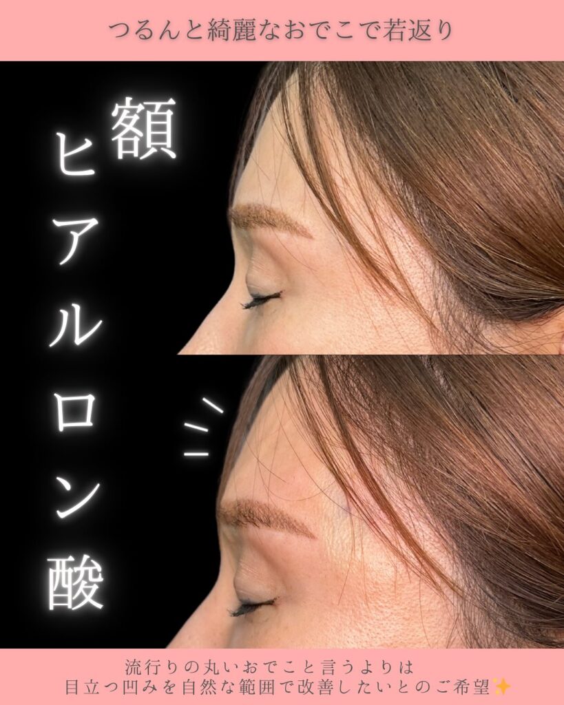 額のヒアルロン酸の症例写真