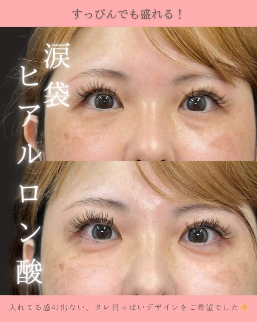 涙袋のヒアルロン酸の症例写真 (2)