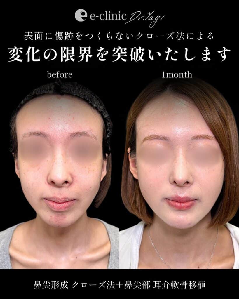 鼻尖形成と耳介軟骨移植の症例写真 (5)