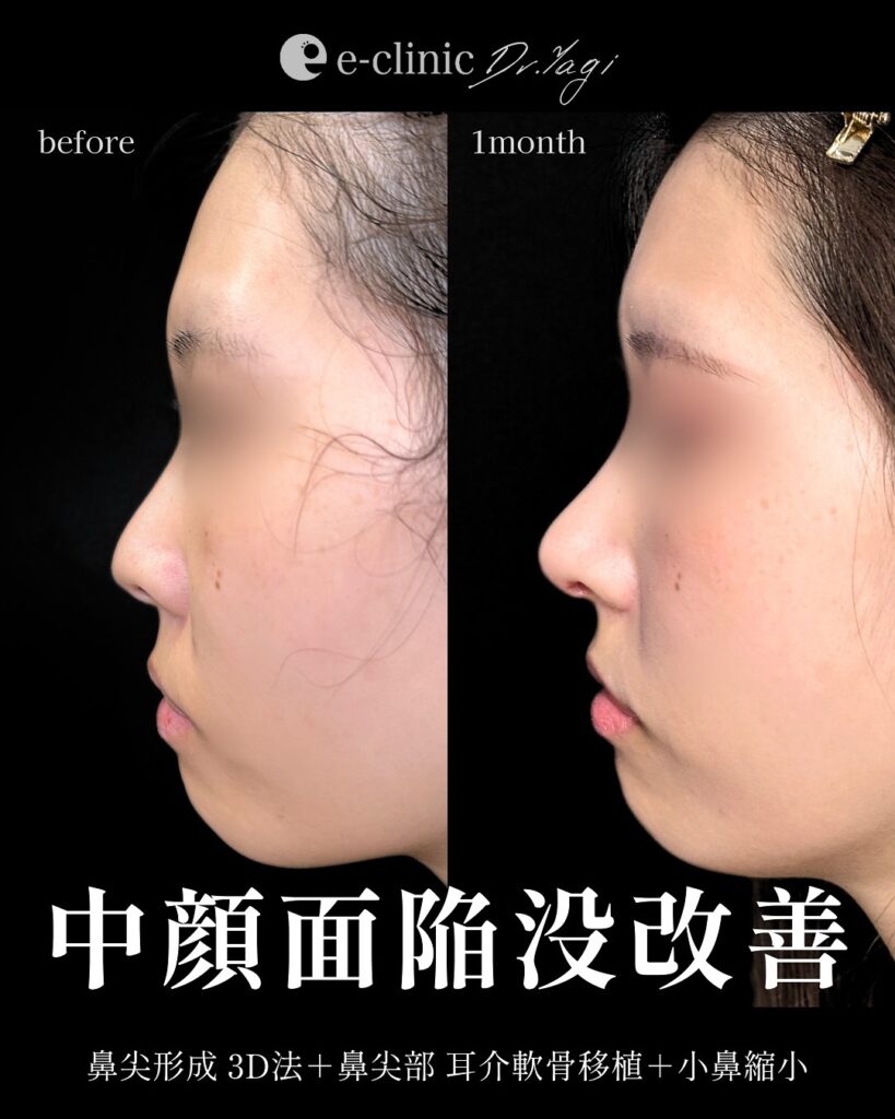 鼻尖形成3D法と耳介軟骨移植と小鼻縮小の症例写真 (1)