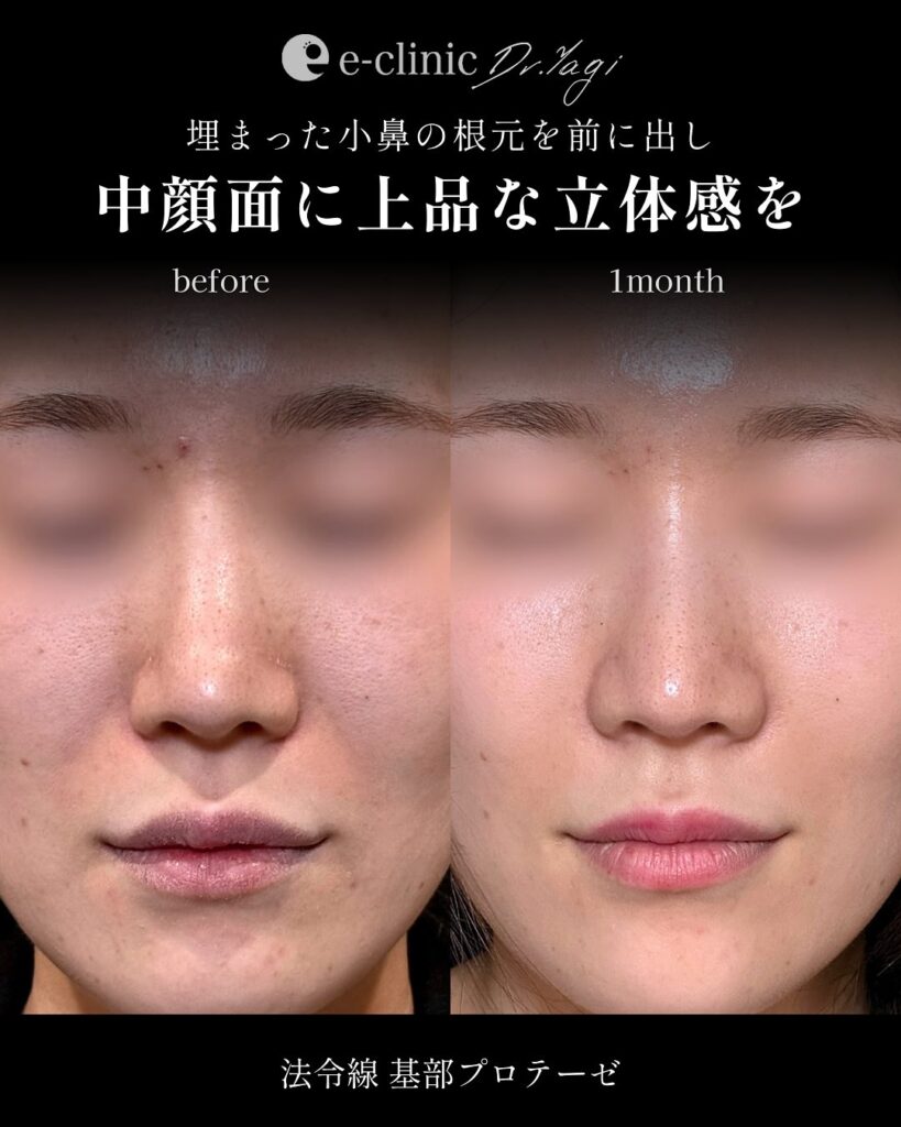 貴族手術の症例写真 (3)