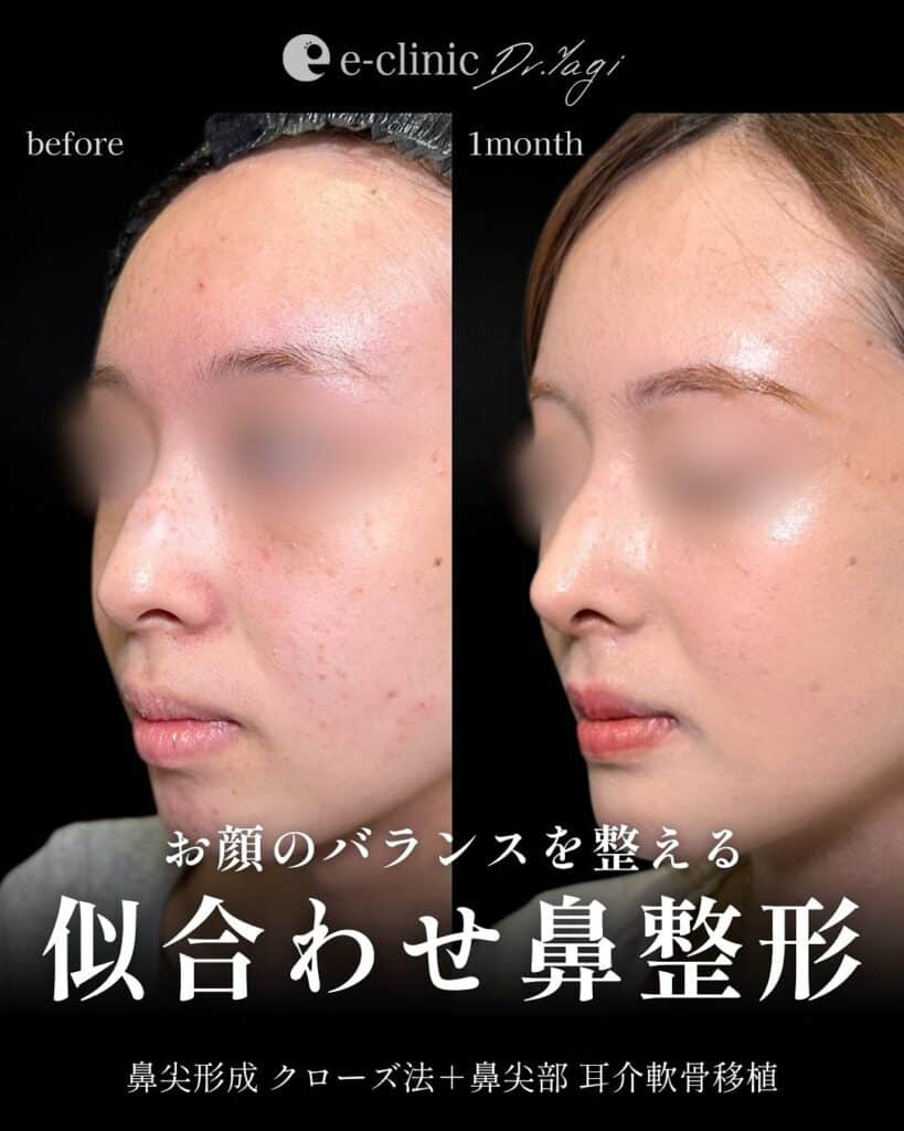 鼻尖形成と耳介軟骨移植の症例写真 (3)