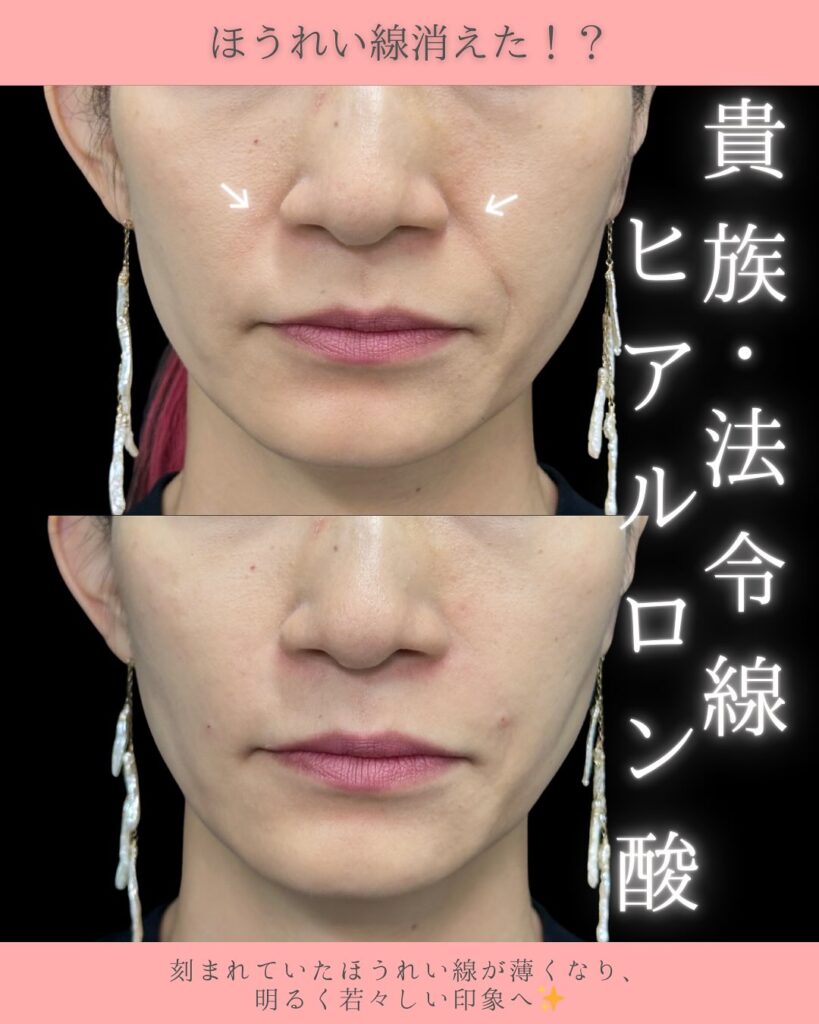 貴族ヒアルロン酸の症例写真 (2)