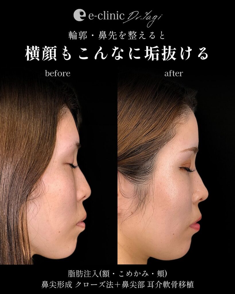 鼻尖形成と耳介軟骨移植と脂肪注入の症例写真 (3)