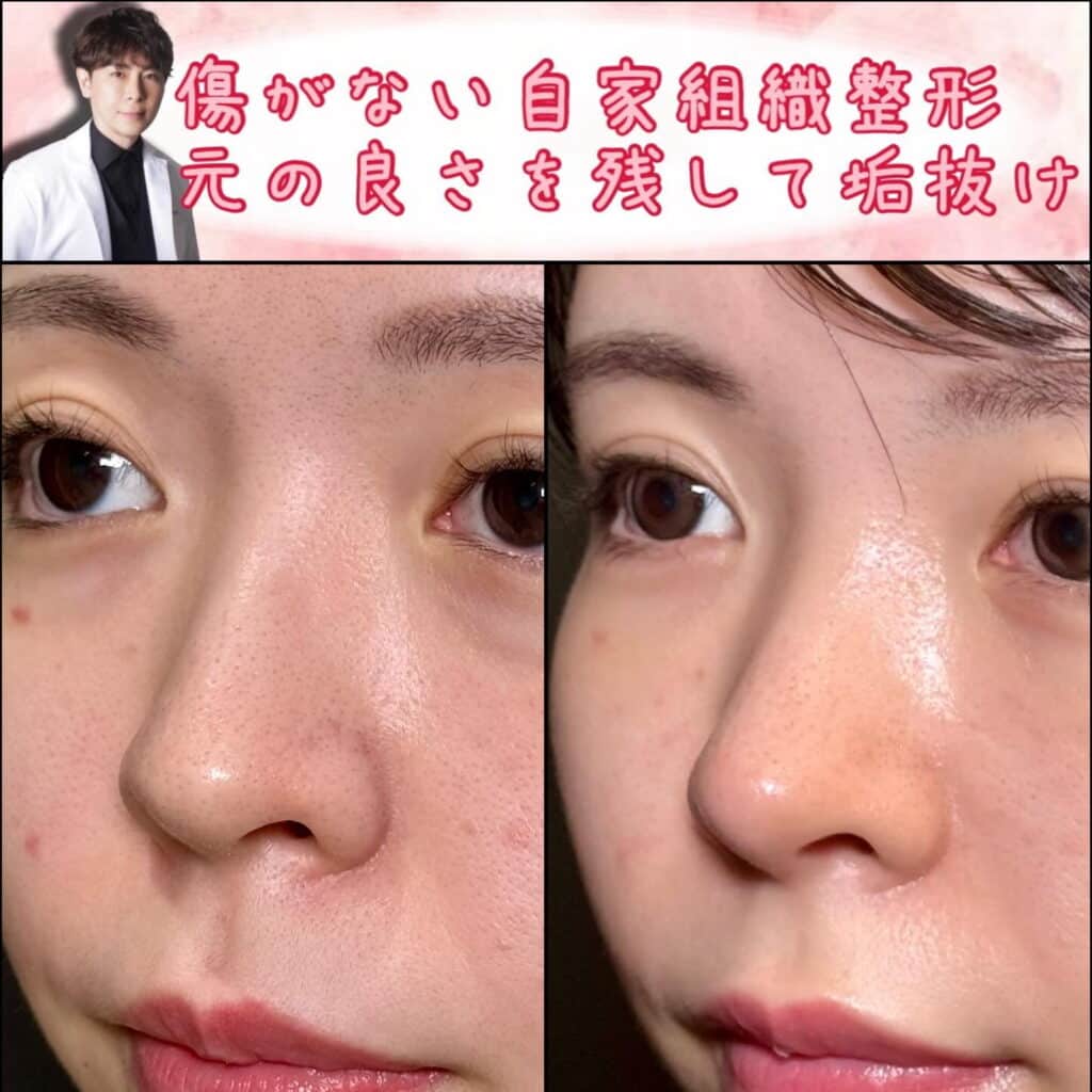 斜め右から見たクローズド法の鼻尖形成と軟骨移植の症例写真