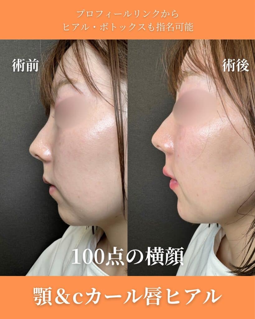 顎と唇にヒアルロン酸を注入した症例写真