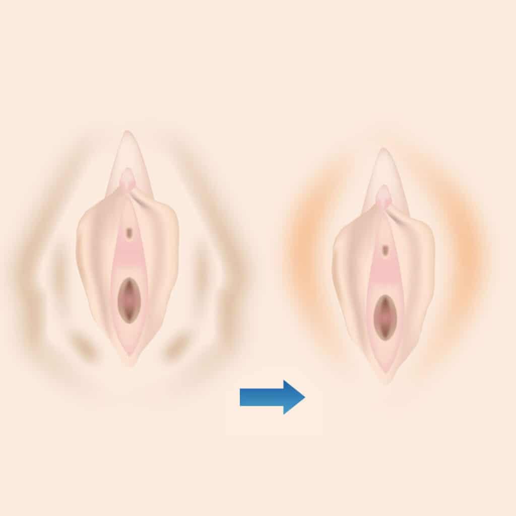 大陰唇縮小手術の図解