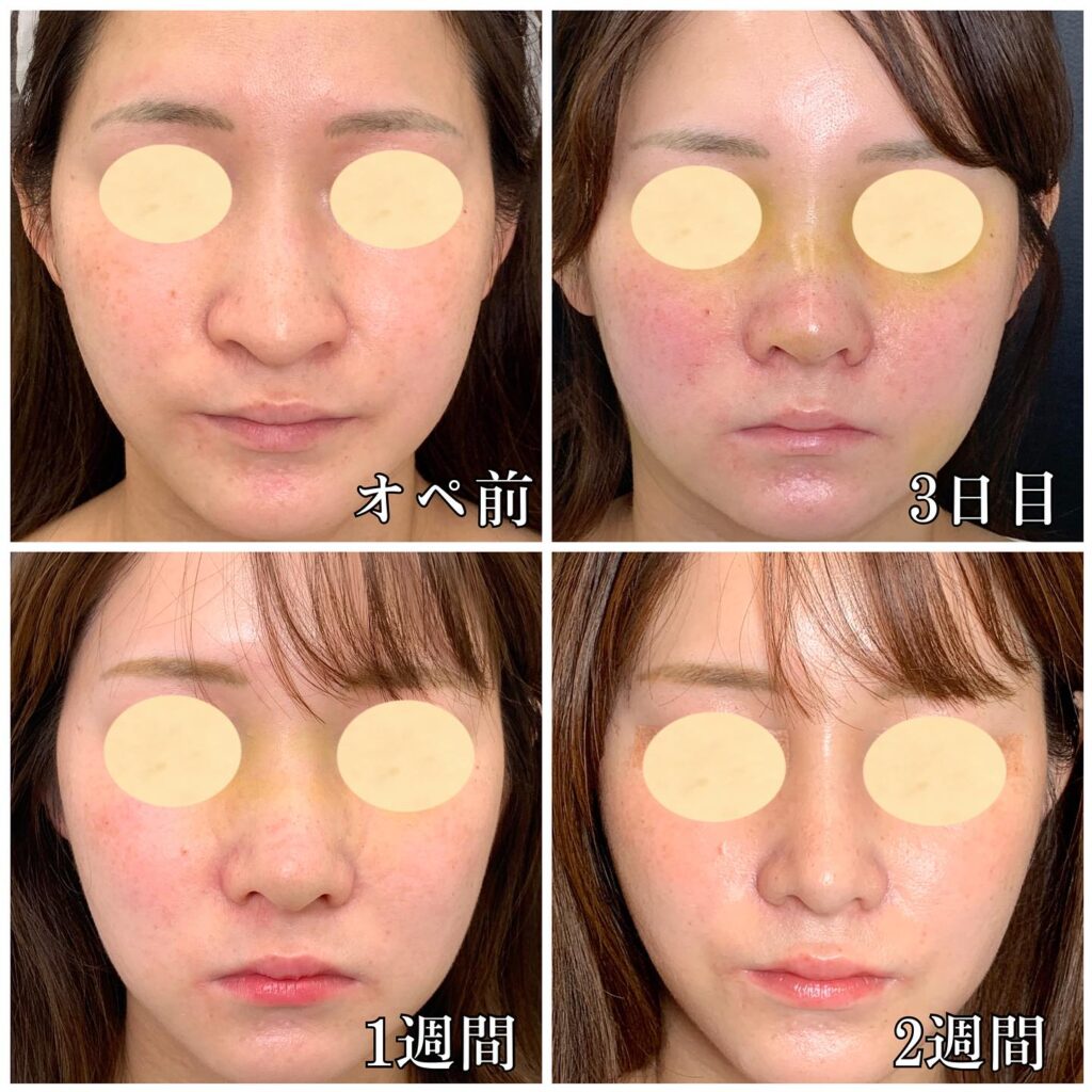 鼻骨骨切りの経過の症例写真