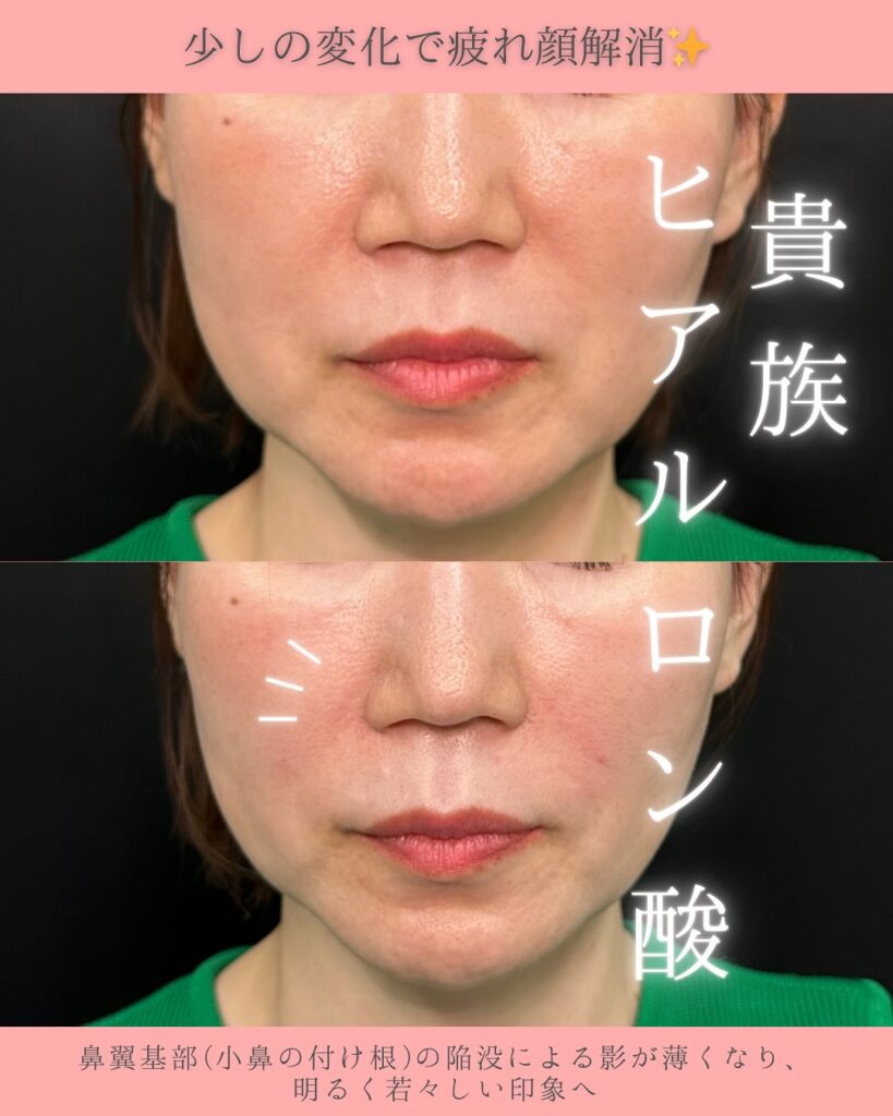 貴族ヒアルロン酸の症例写真 (1)