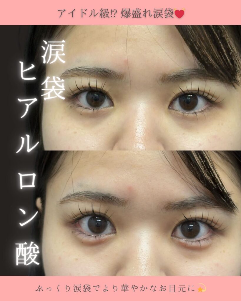 涙袋のヒアルロン酸の症例写真 (1)