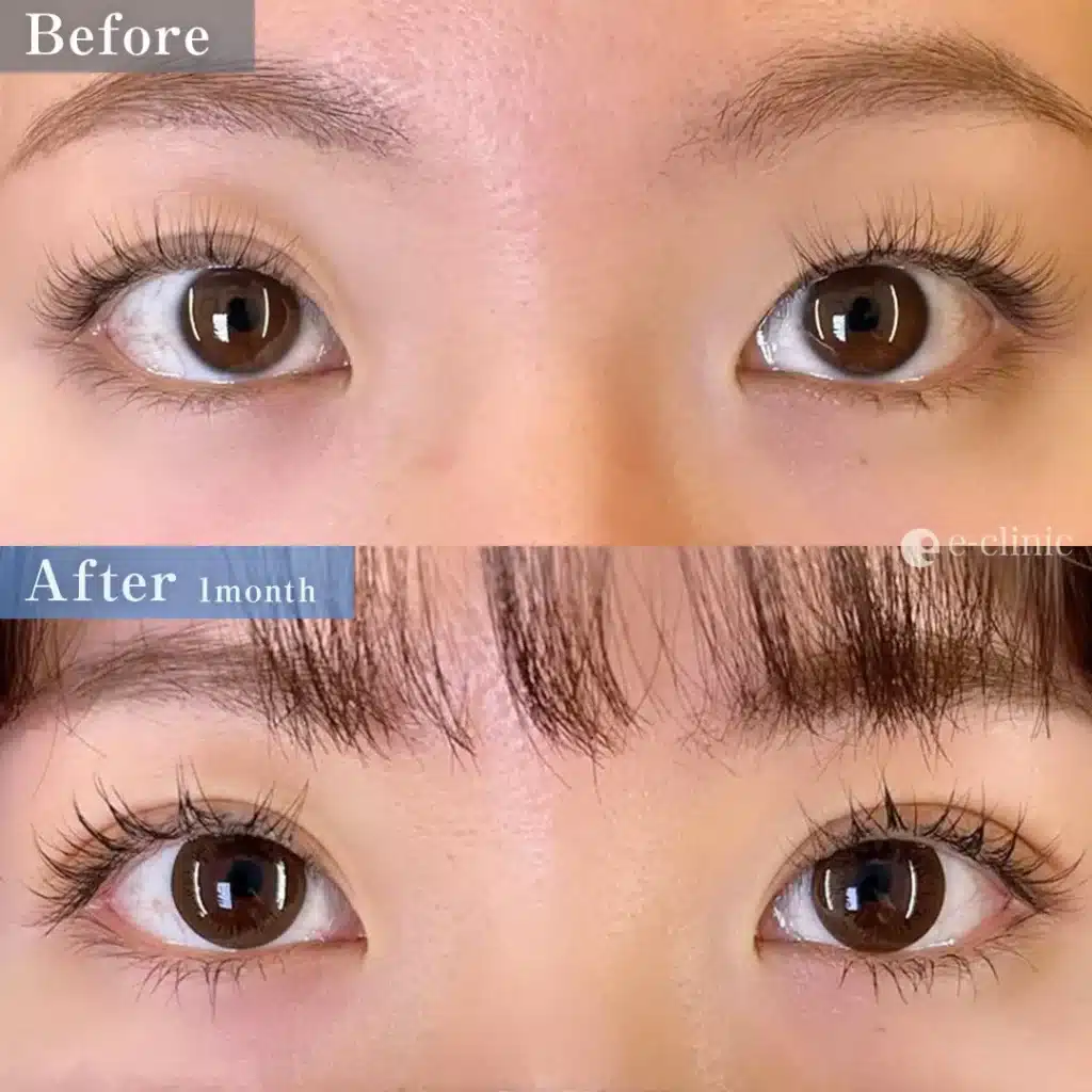 二重埋没法 クイックループダブル4点裏留め(名医の島田医師が執刀)