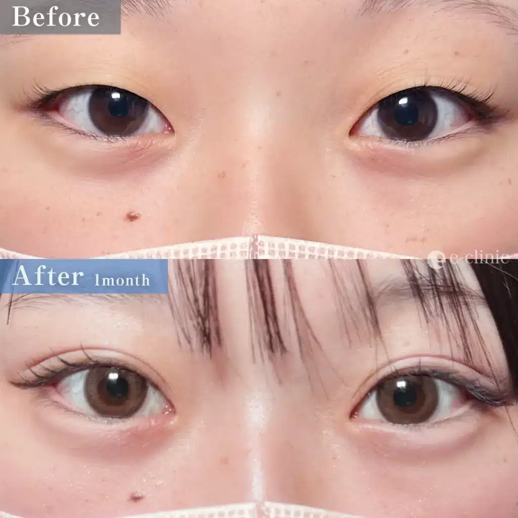 二重埋没法 自然癒着(名医の伊藤医師が執刀)