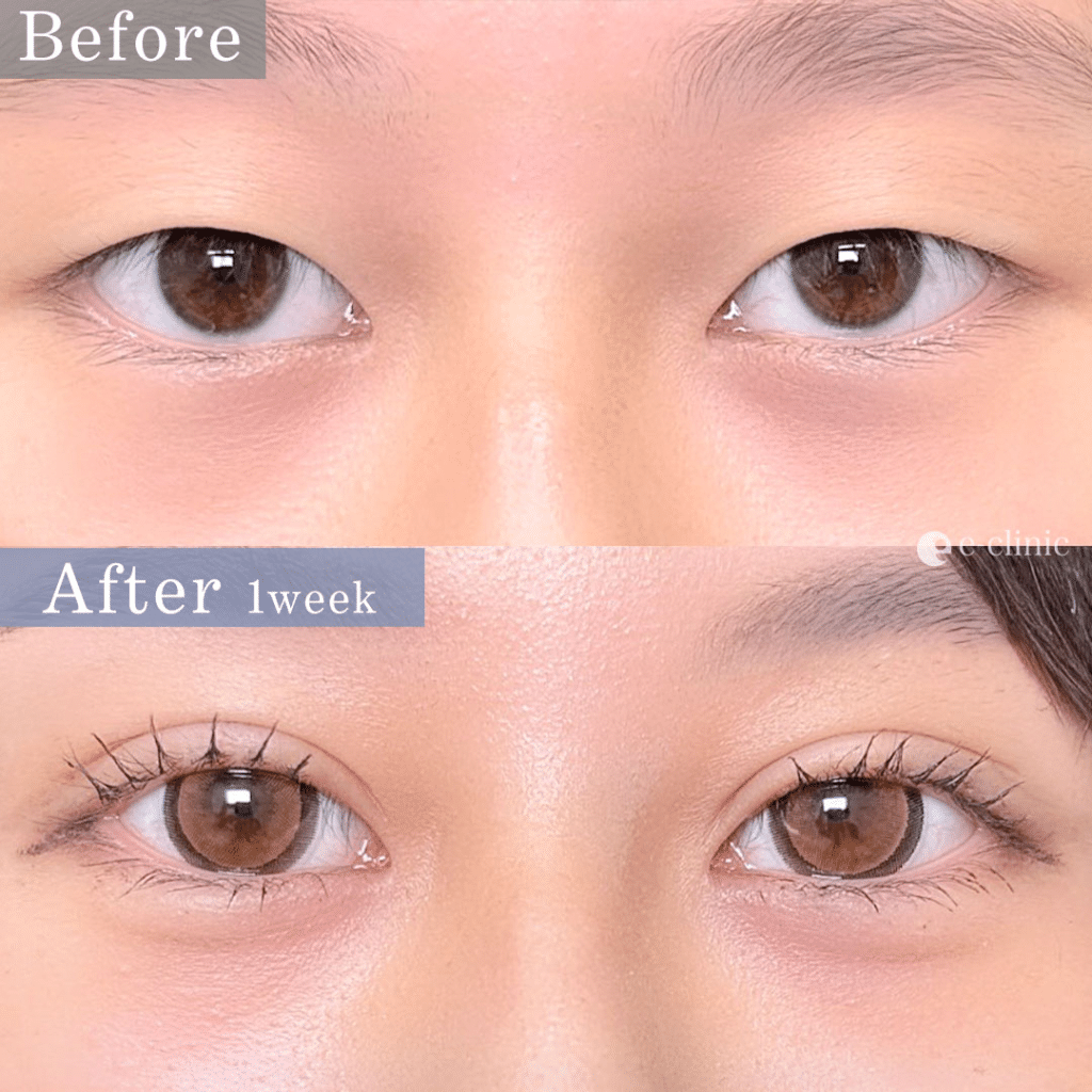 二重埋没 自然癒着法（名医の相原医師が執刀）