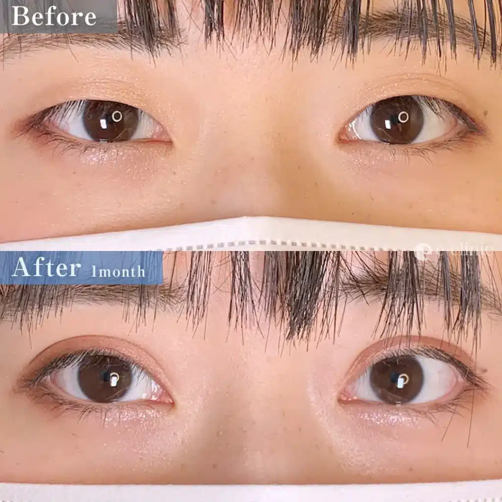 二重埋没法 特殊6点留め(名医の張田医師が執刀)