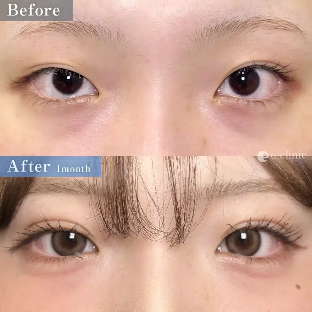 eclinicの二重症例（デザイン）
二重埋没法　自然癒着（名医の劉医師が執刀）