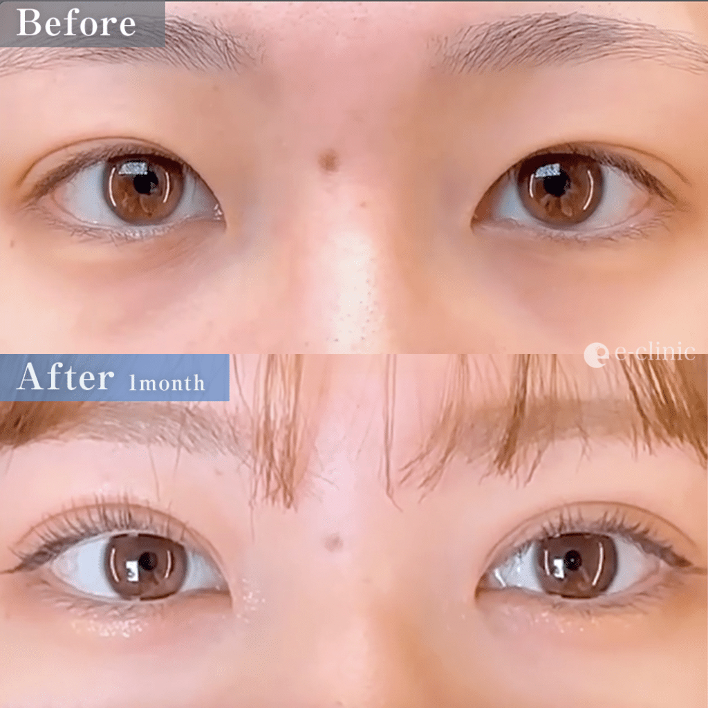 二重埋没法 クイックループダブル4点裏留め（名医の島田医師が執刀）