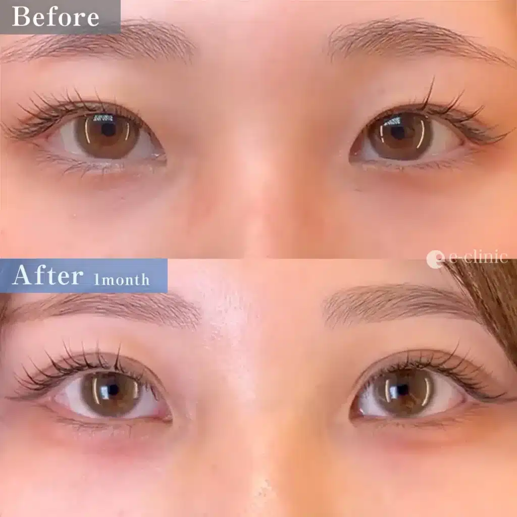 二重埋没法 クイックループダブル4点裏留め(名医の島田医師が執刀)