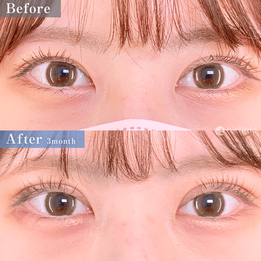 eclinicの二重症例（デザイン）
全切開二重術（名医の張田医師が執刀）