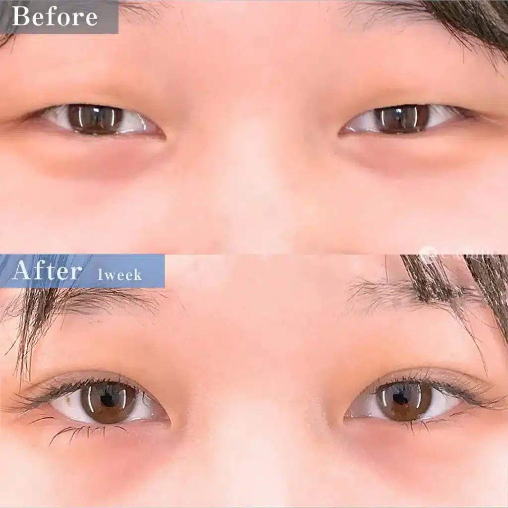 eclinicの二重症例（デザイン）
二重埋没法　特殊6裏留め（名医の坂本医師が執刀）