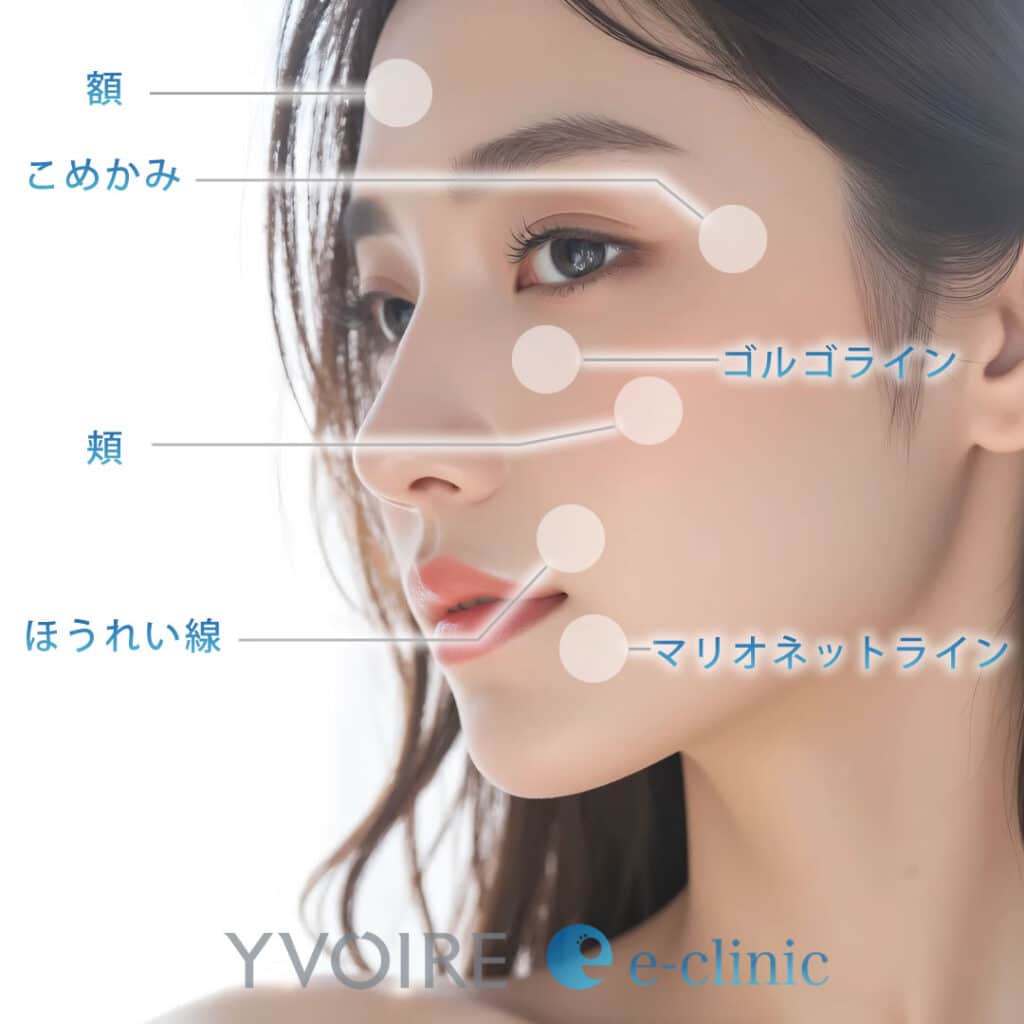 イボアール クラシック プラスの注入部位の図解