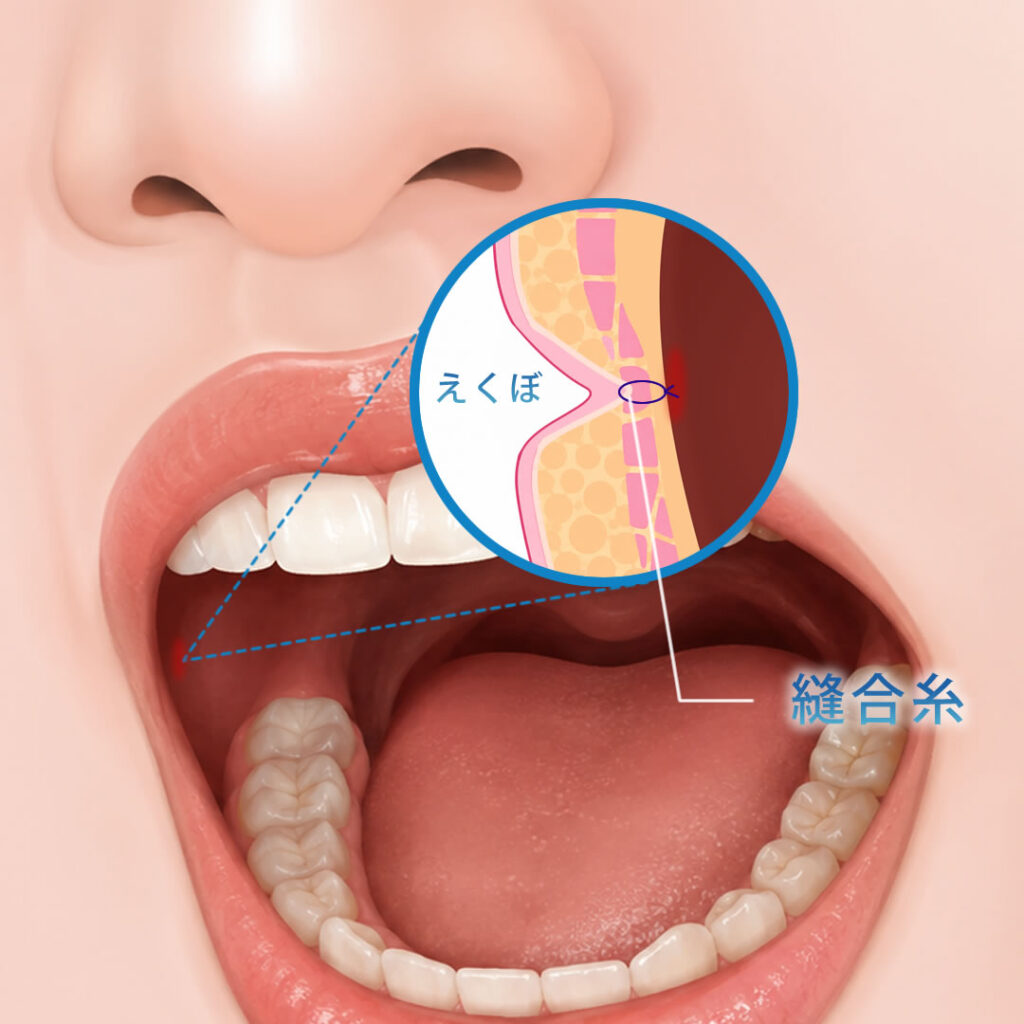 えくぼ形成の口腔内から糸で真皮と表情筋を結んでいる図解